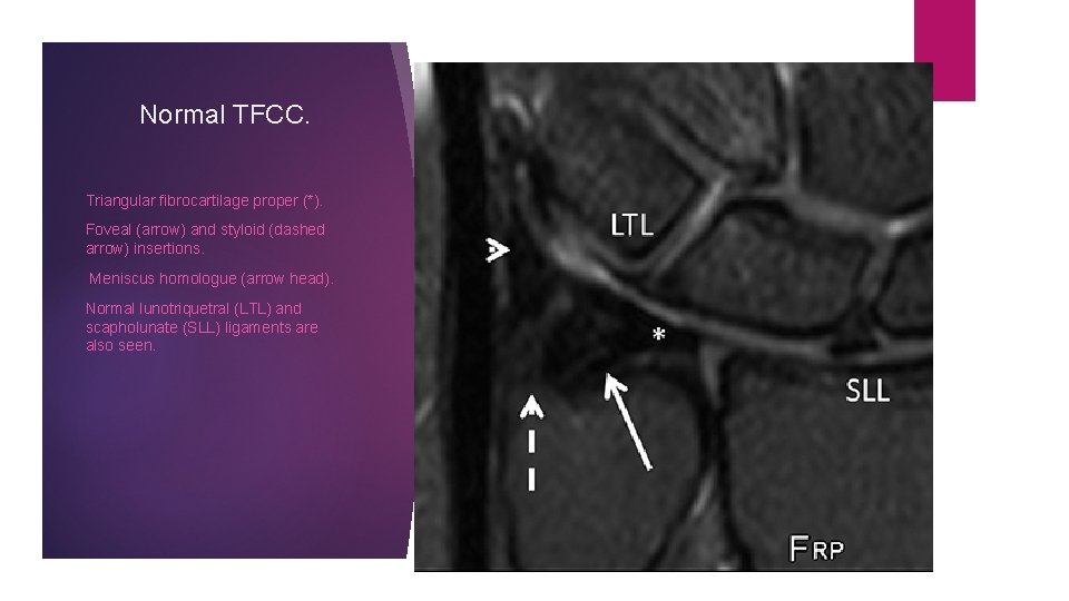 Normal TFCC. Triangular fibrocartilage proper (*). Foveal (arrow) and styloid (dashed arrow) insertions. Meniscus