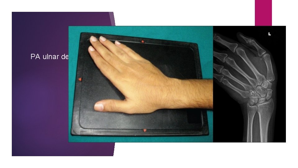 PA ulnar deviation 