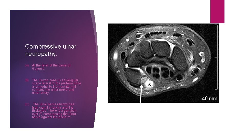 Compressive ulnar neuropathy. (A) At the level of the canal of Guyon’s. (B) The