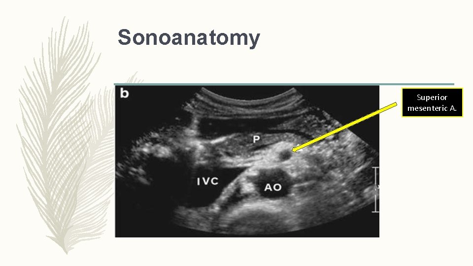 Sonoanatomy Superior mesenteric A. 