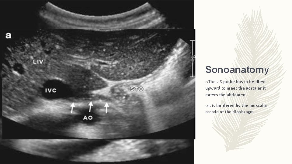 Sonoanatomy o. The US probe has to be tilted upward to meet the aorta