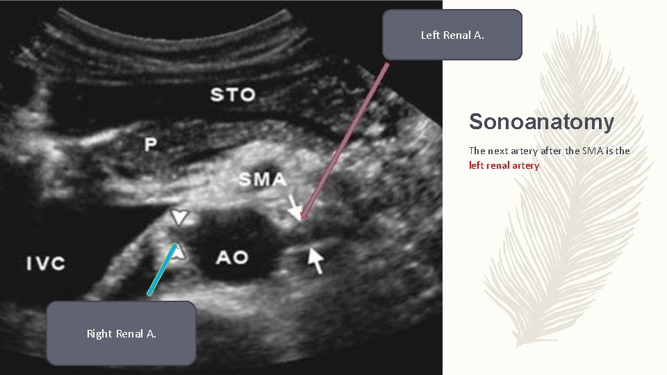 Left Renal A. Sonoanatomy The next artery after the SMA is the left renal