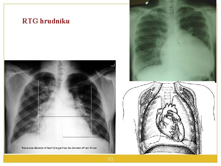 RTG hrudníku 23 