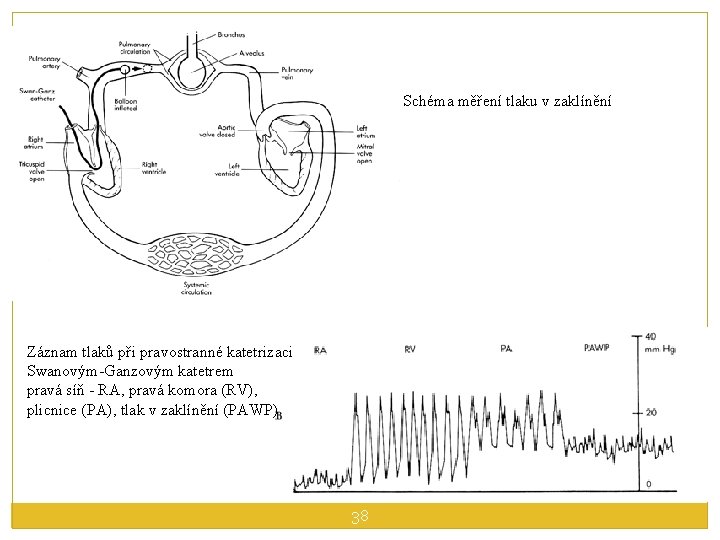 Schéma měření tlaku v zaklínění Záznam tlaků při pravostranné katetrizaci Swanovým-Ganzovým katetrem pravá síň