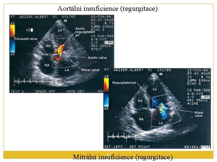 Aortální insuficience (regurgitace) 43 Mitrální insuficience (regurgitace) 