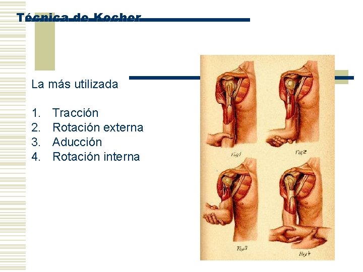 Técnica de Kocher La más utilizada 1. 2. 3. 4. Tracción Rotación externa Aducción