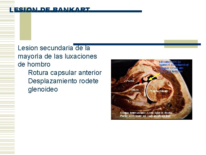 LESION DE BANKART Lesion secundaria de la mayoría de las luxaciones de hombro Rotura