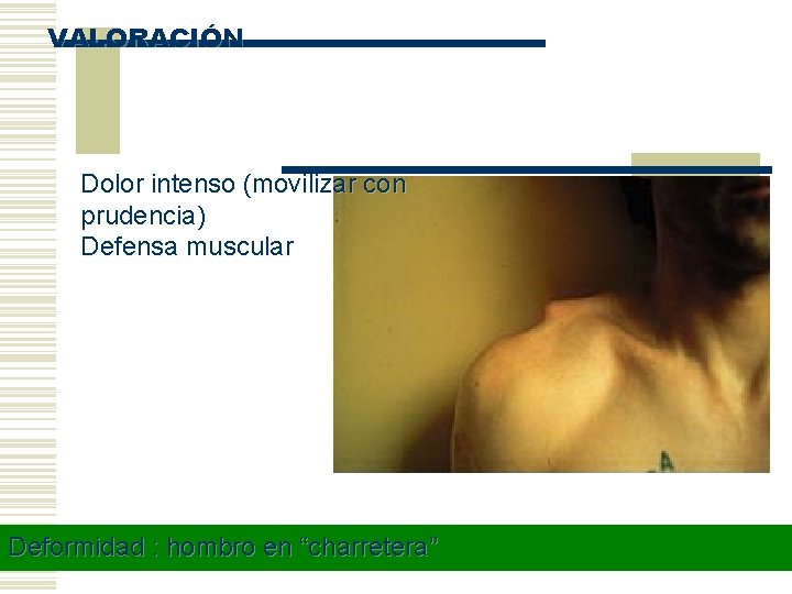 VALORACIÓN Dolor intenso (movilizar con prudencia) Defensa muscular Deformidad : hombro en “charretera” ©Angel