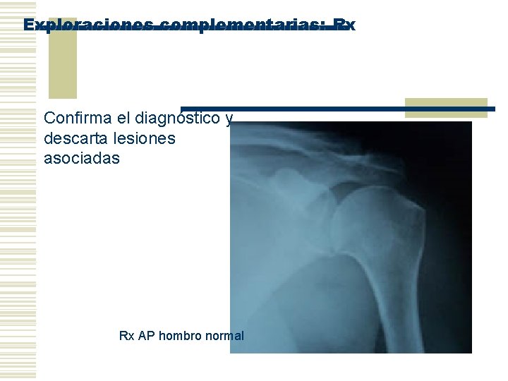 Exploraciones complementarias: Rx Confirma el diagnóstico y descarta lesiones asociadas Rx AP hombro normal