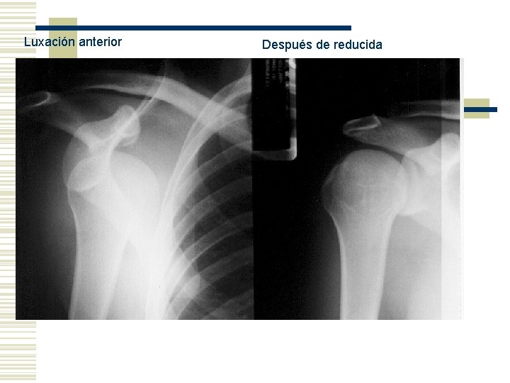Luxación anterior Después de reducida 