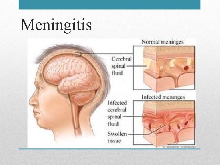 Meningitis 