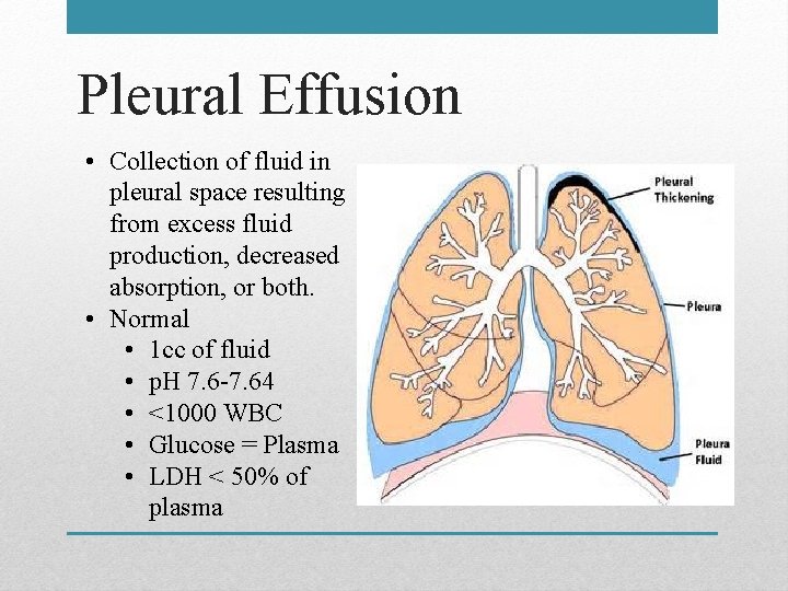 Pleural Effusion • Collection of fluid in pleural space resulting from excess fluid production,