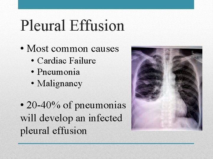 Pleural Effusion • Most common causes • Cardiac Failure • Pneumonia • Malignancy •