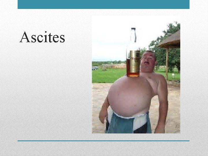 Ascites 