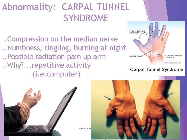 Abnormality: CARPAL TUNNEL SYNDROME. . Compression on the median nerve. . Numbness, tingling, burning