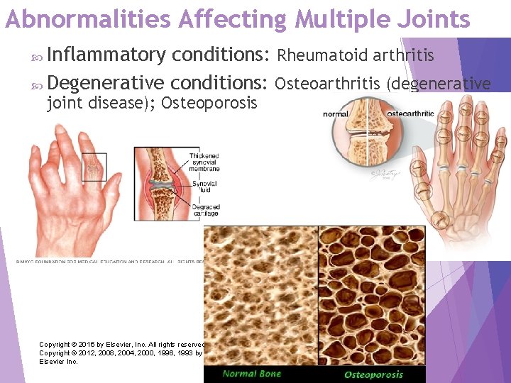 Abnormalities Affecting Multiple Joints Inflammatory conditions: Rheumatoid arthritis Degenerative conditions: Osteoarthritis (degenerative joint disease);