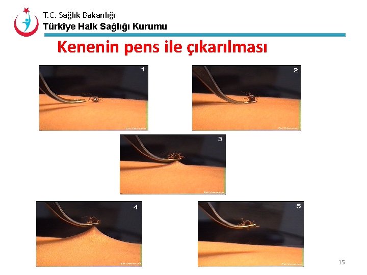 T. C. Sağlık Bakanlığı Türkiye Halk Sağlığı Kurumu Kenenin pens ile çıkarılması 15 