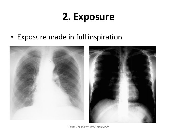 2. Exposure • Exposure made in full inspiration Basics Chest Xray: Dr Sheetu Singh