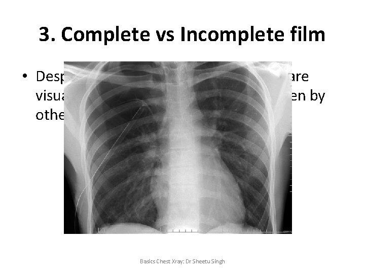 3. Complete vs Incomplete film • Despite best efforts only 60% of lungs are
