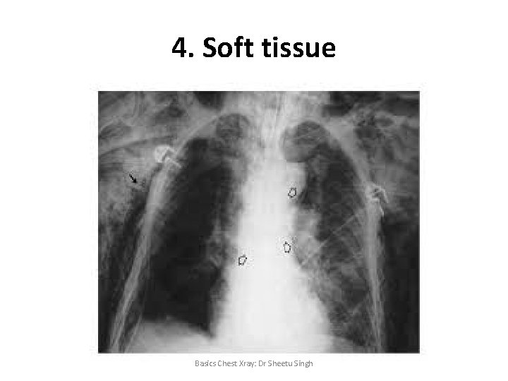 4. Soft tissue Basics Chest Xray: Dr Sheetu Singh 