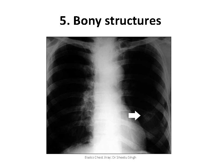 5. Bony structures Basics Chest Xray: Dr Sheetu Singh 