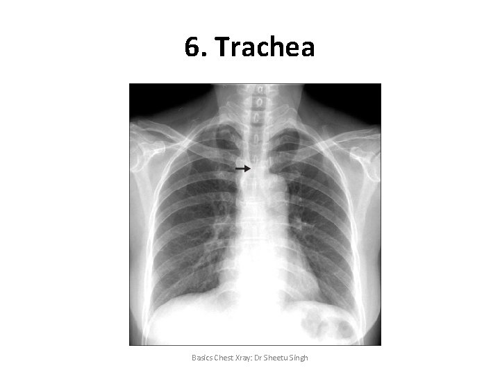 6. Trachea Basics Chest Xray: Dr Sheetu Singh 