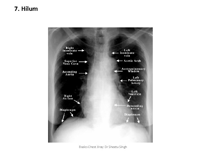 7. Hilum Basics Chest Xray: Dr Sheetu Singh 