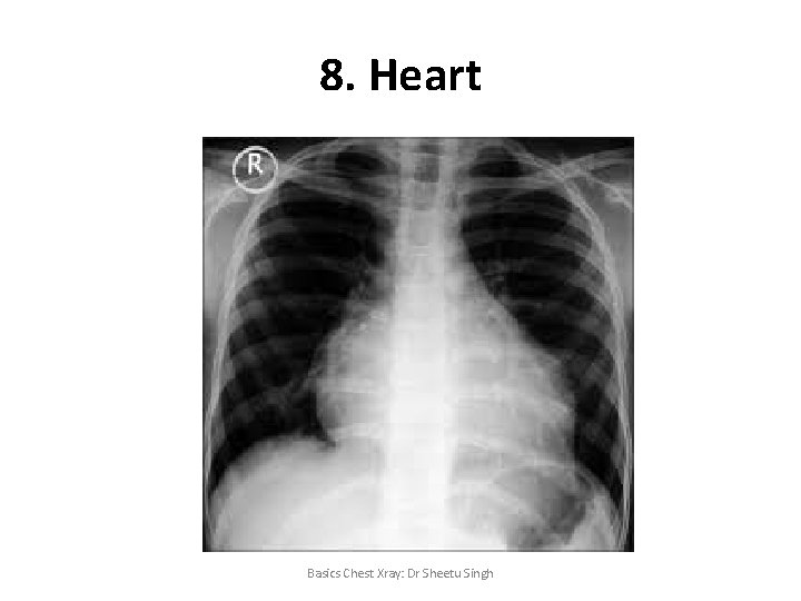 8. Heart Basics Chest Xray: Dr Sheetu Singh 