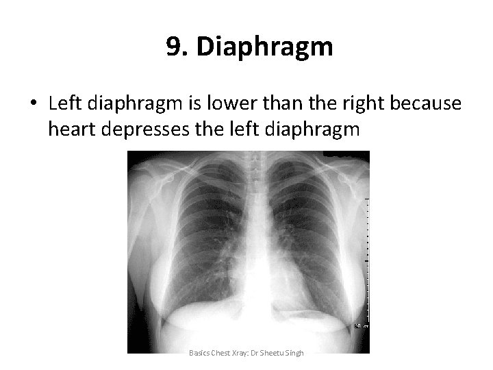 9. Diaphragm • Left diaphragm is lower than the right because heart depresses the