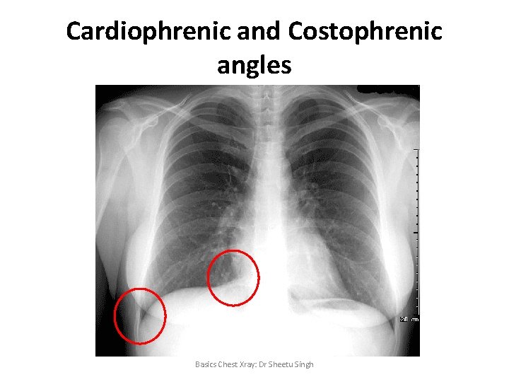 Cardiophrenic and Costophrenic angles Basics Chest Xray: Dr Sheetu Singh 