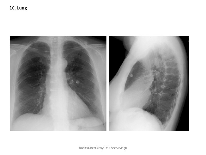 10. Lung Basics Chest Xray: Dr Sheetu Singh 