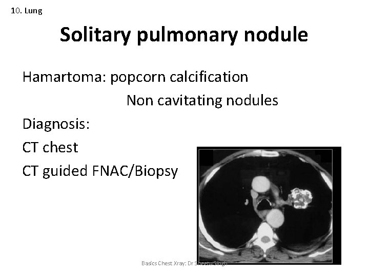 10. Lung Solitary pulmonary nodule Hamartoma: popcorn calcification Non cavitating nodules Diagnosis: CT chest