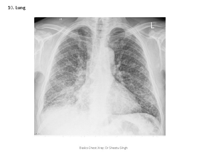 10. Lung Basics Chest Xray: Dr Sheetu Singh 