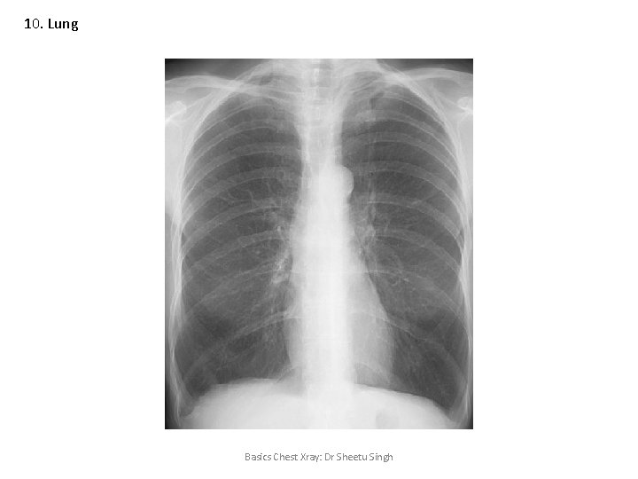 10. Lung Basics Chest Xray: Dr Sheetu Singh 