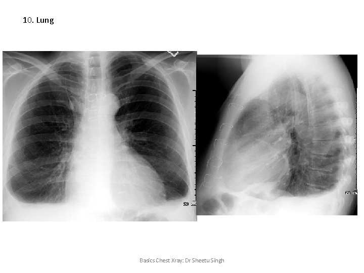10. Lung Basics Chest Xray: Dr Sheetu Singh 