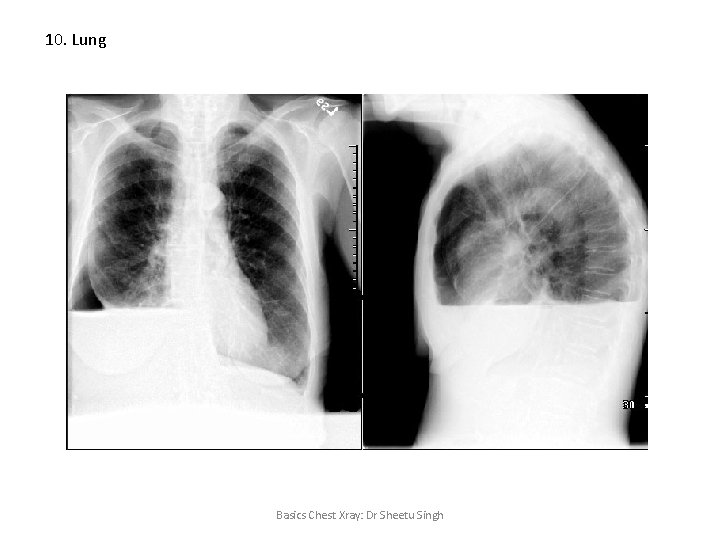 10. Lung Basics Chest Xray: Dr Sheetu Singh 