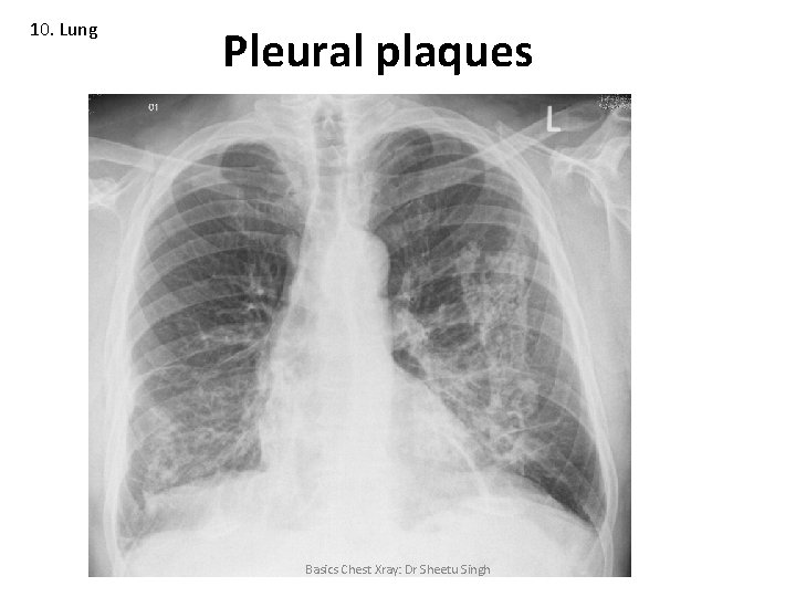 10. Lung Pleural plaques Basics Chest Xray: Dr Sheetu Singh 