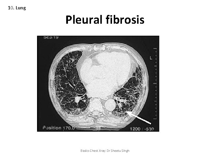 10. Lung Pleural fibrosis Basics Chest Xray: Dr Sheetu Singh 