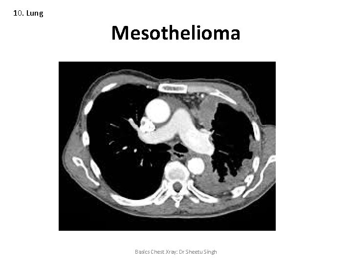 10. Lung Mesothelioma Basics Chest Xray: Dr Sheetu Singh 