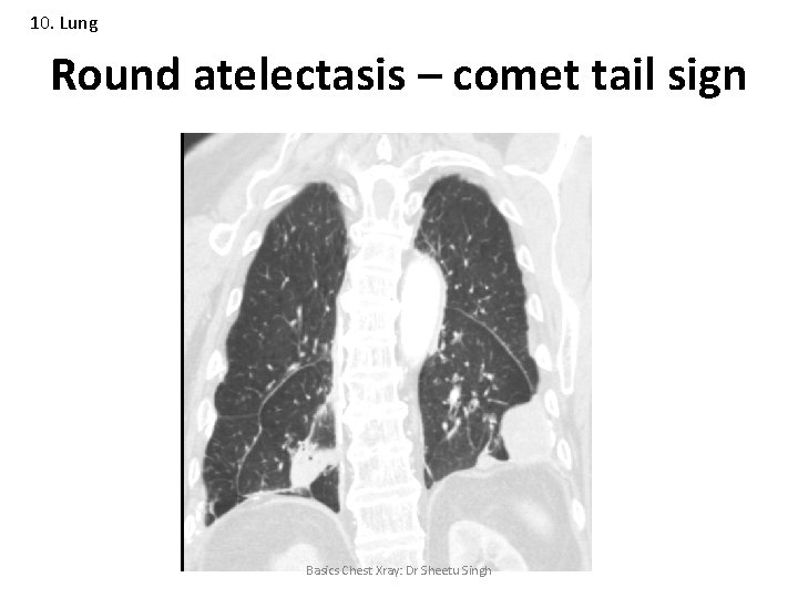 10. Lung Round atelectasis – comet tail sign Basics Chest Xray: Dr Sheetu Singh