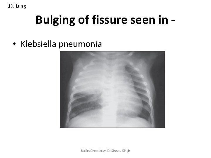10. Lung Bulging of fissure seen in • Klebsiella pneumonia Basics Chest Xray: Dr