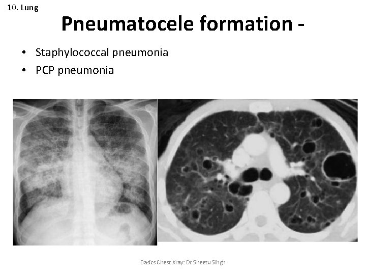 10. Lung Pneumatocele formation - • Staphylococcal pneumonia • PCP pneumonia Basics Chest Xray: