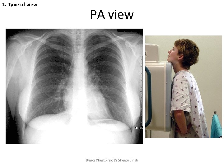 1. Type of view PA view Basics Chest Xray: Dr Sheetu Singh 