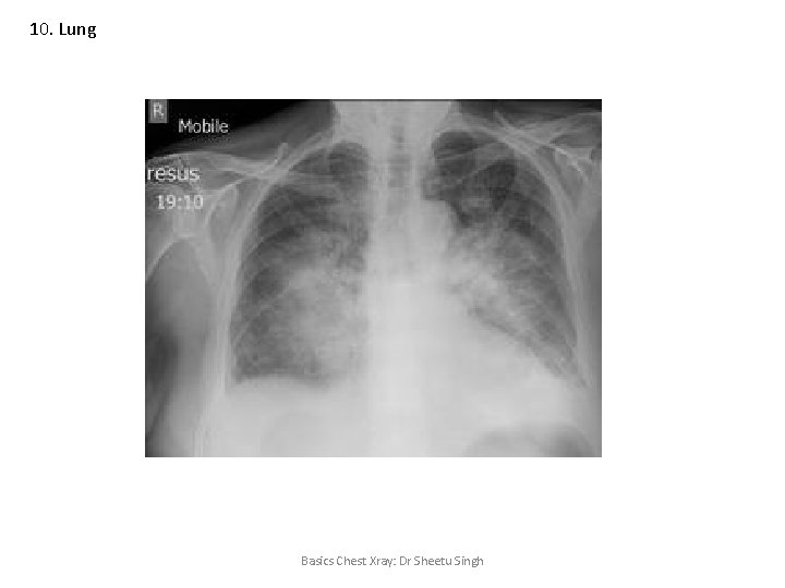 10. Lung Basics Chest Xray: Dr Sheetu Singh 