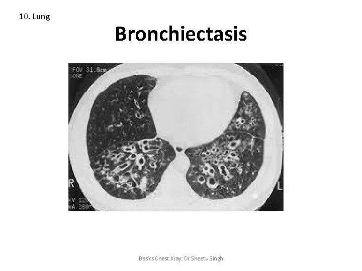 10. Lung Bronchiectasis Basics Chest Xray: Dr Sheetu Singh 