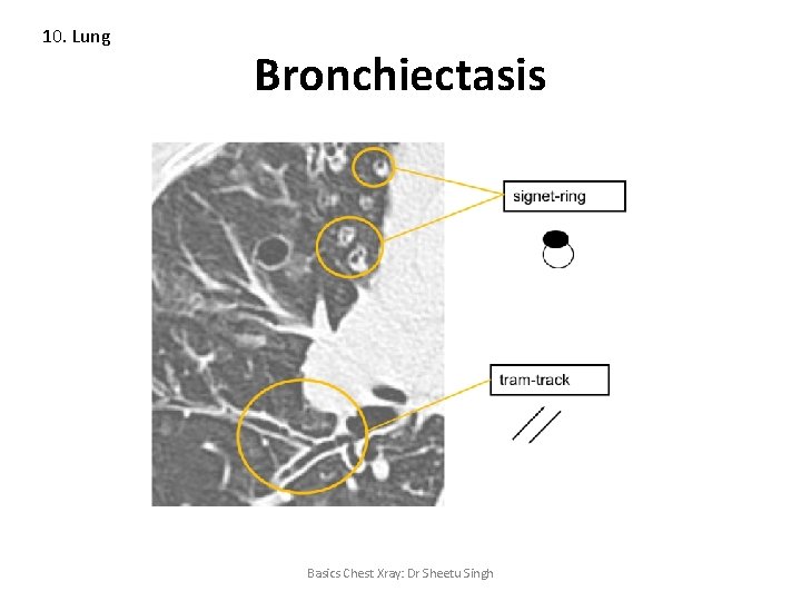 10. Lung Bronchiectasis Basics Chest Xray: Dr Sheetu Singh 