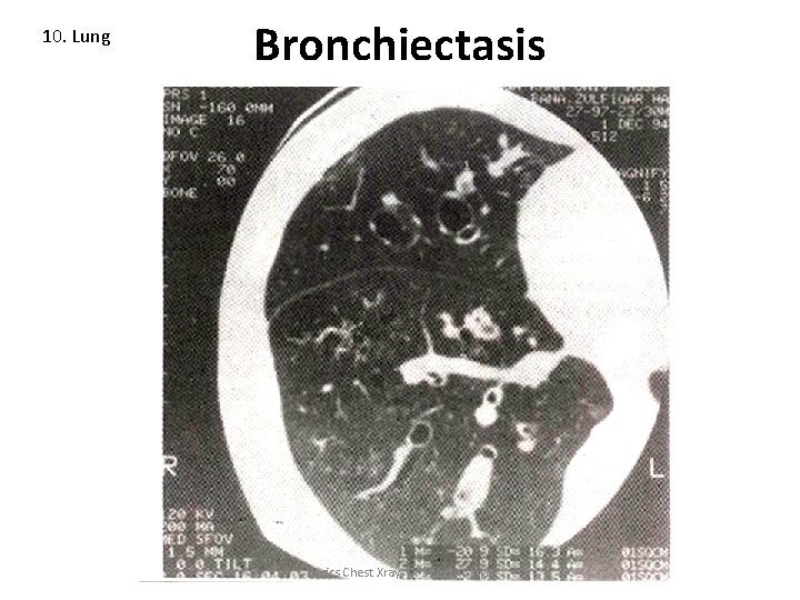 10. Lung Bronchiectasis Basics Chest Xray: Dr Sheetu Singh 