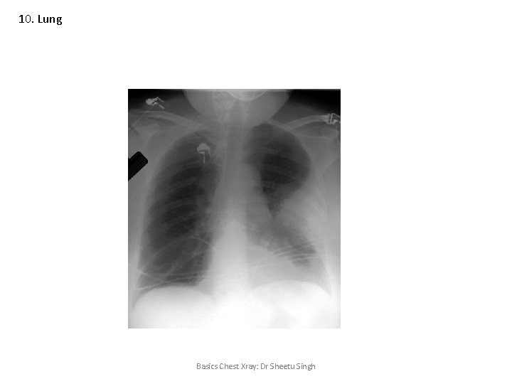 10. Lung Basics Chest Xray: Dr Sheetu Singh 