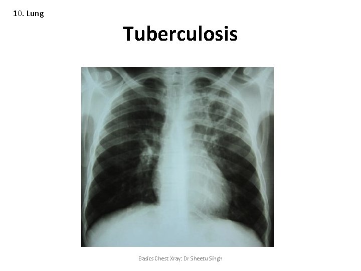 10. Lung Tuberculosis Basics Chest Xray: Dr Sheetu Singh 