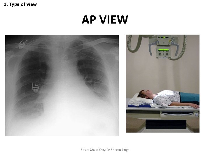 1. Type of view AP VIEW Basics Chest Xray: Dr Sheetu Singh 